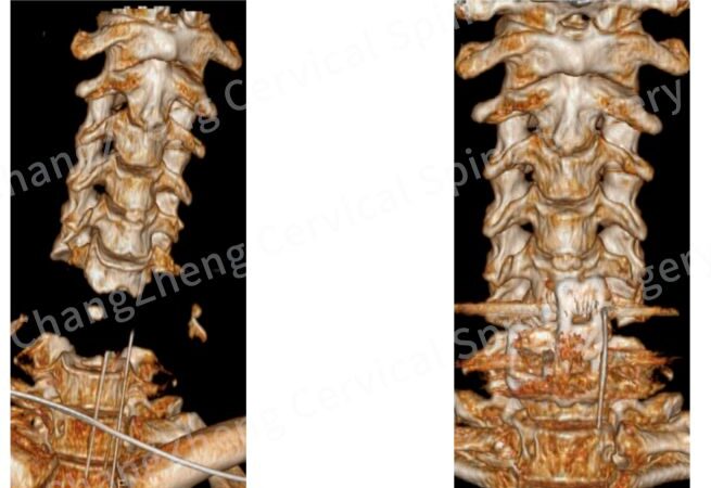 Chine : des chirurgiens rassemblent le crâne et la colonne vertébrale d’un patient quasi-décapité